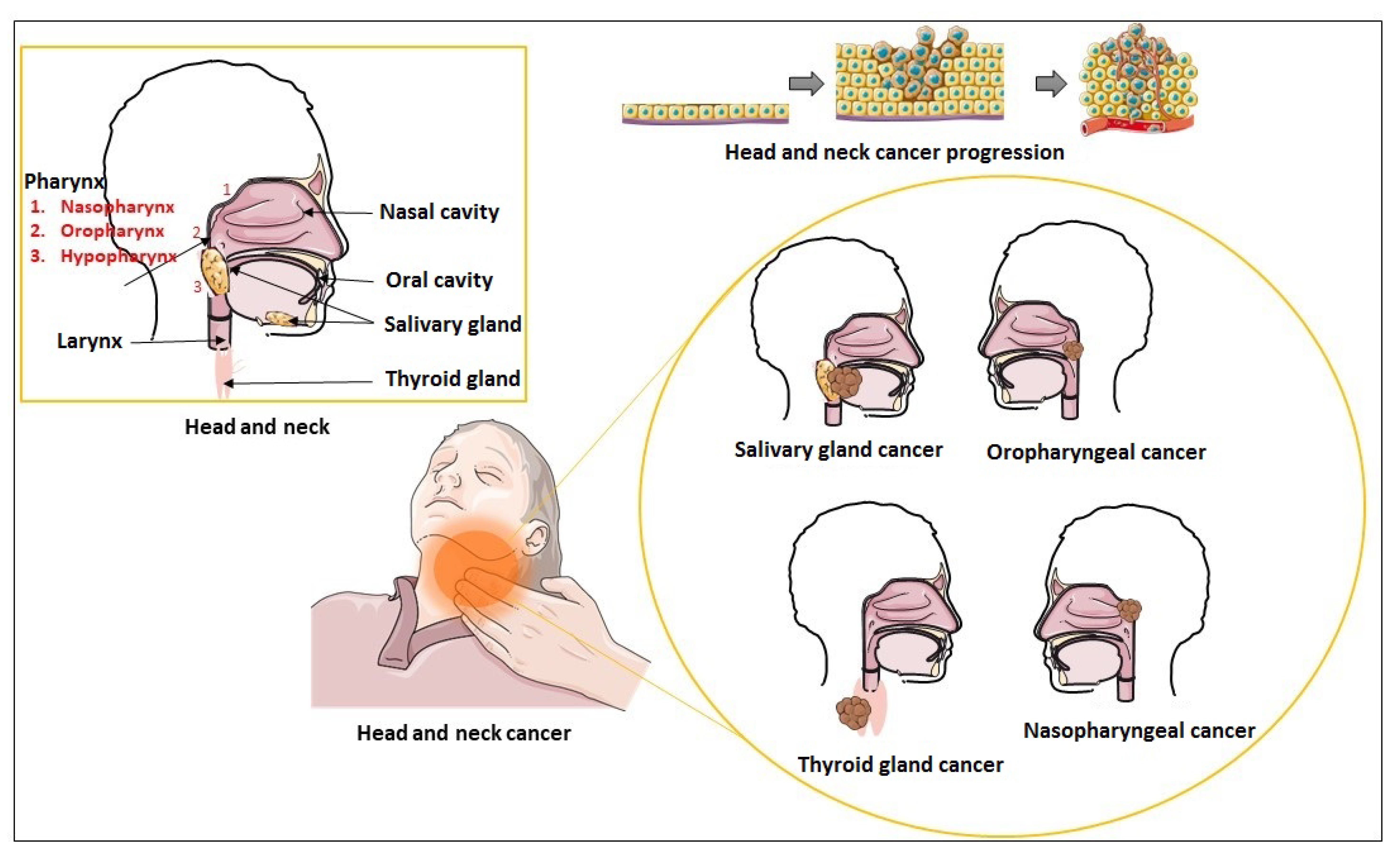 Figure 1 Schematic representation of head and neck region and types of head and neck carcinoma. (Mastronikolis, 2023)