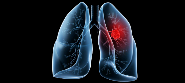 lung cancer