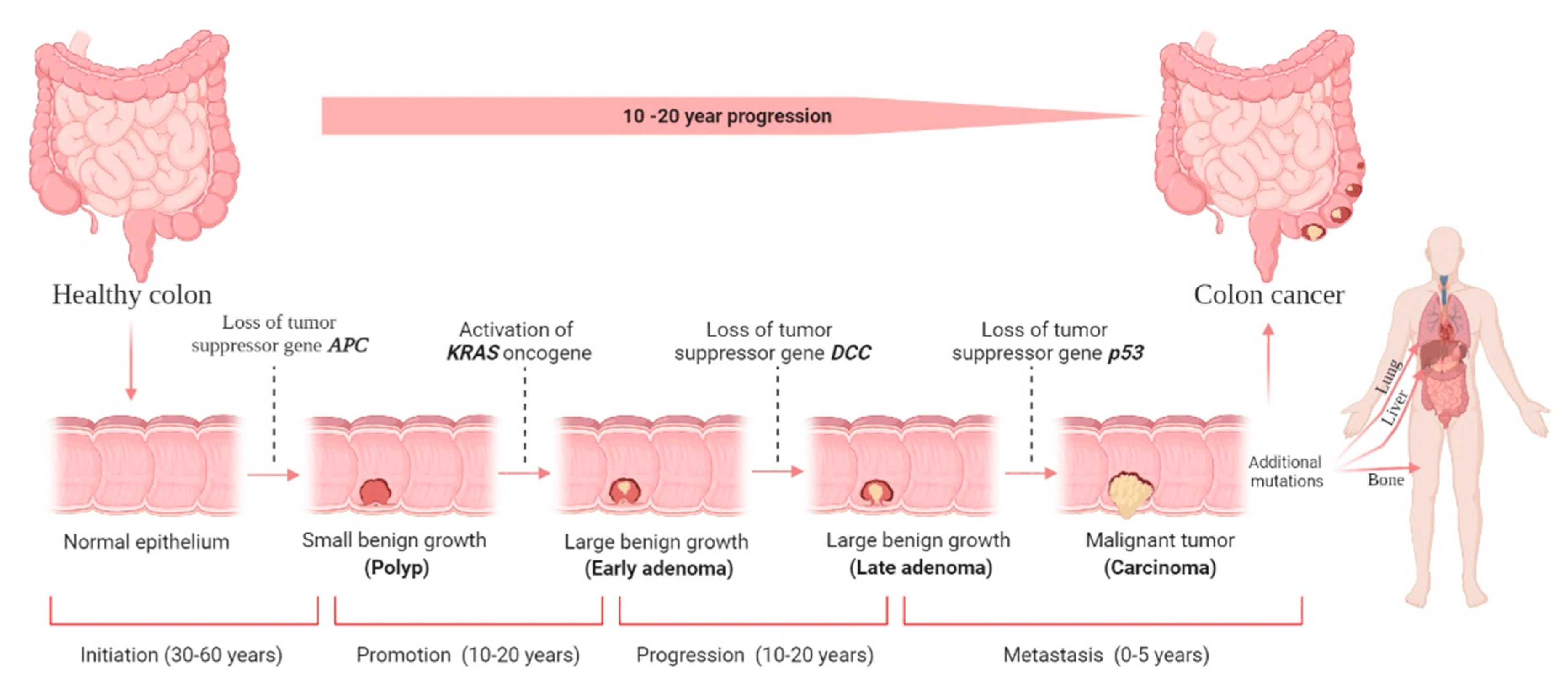 Colorectal cancer (CRC) stages and development